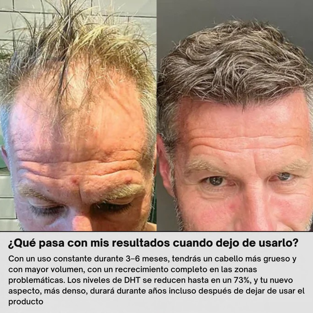 FUSINOVA™ Sistema de Recuperación Capilar